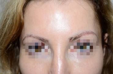 Eyebrow & Beard Restoration - Dr. Jeffrey Epstein, MD, FACS