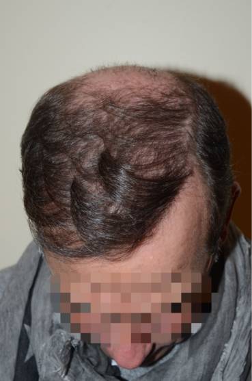 Hair Restoration for Men - Dr. Jeffrey Epstein, MD, FACS