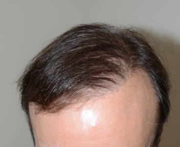 Hair Restoration for Men - Dr. Jeffrey Epstein, MD, FACS