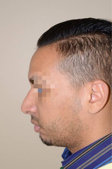 Rhinoplasty - Dr. Jeffrey Epstein, MD, FACS